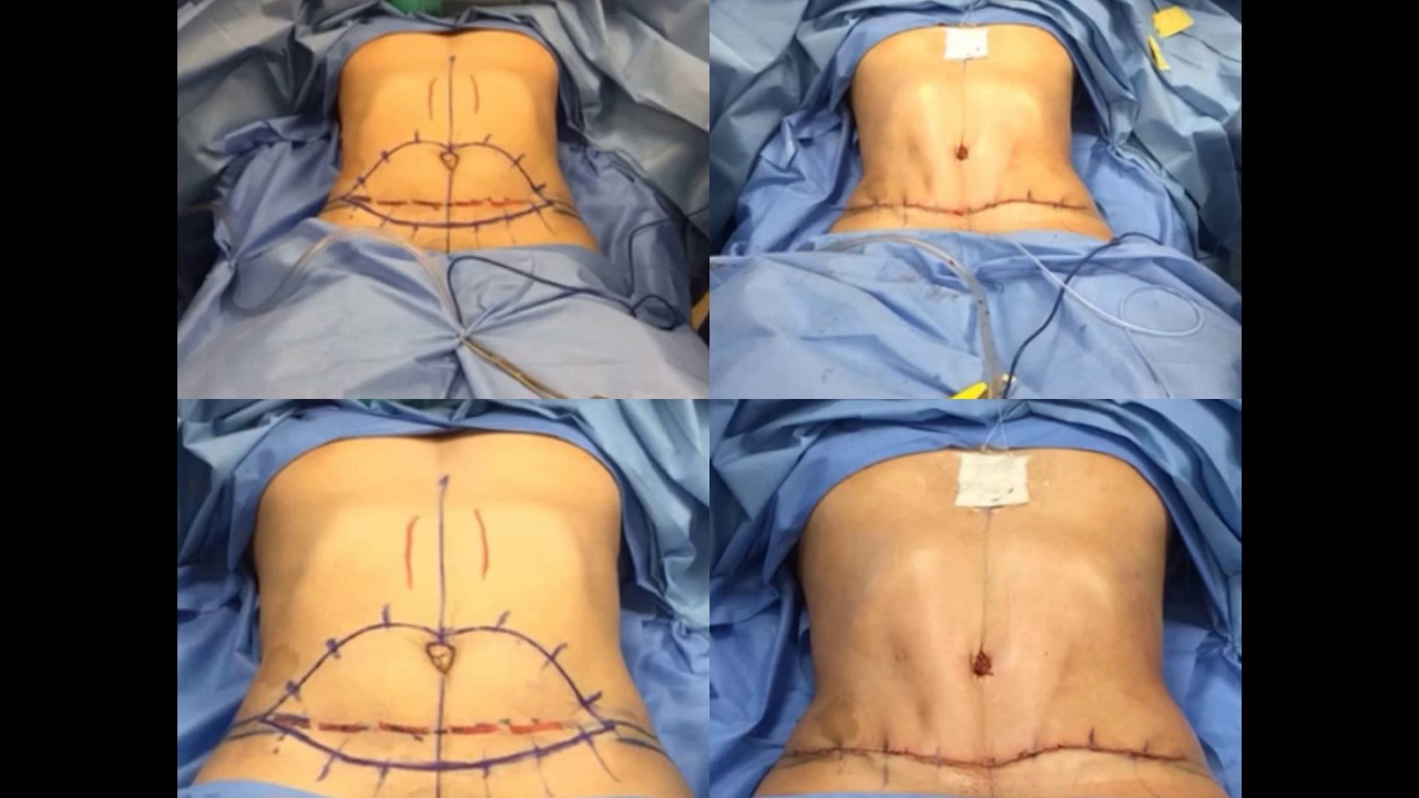 Full Abdominoplasty with Muscle Repair Surgery 