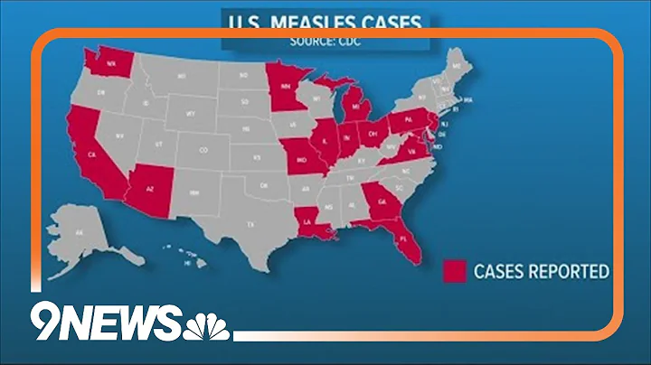 Measles cases on the rise in the U.S.