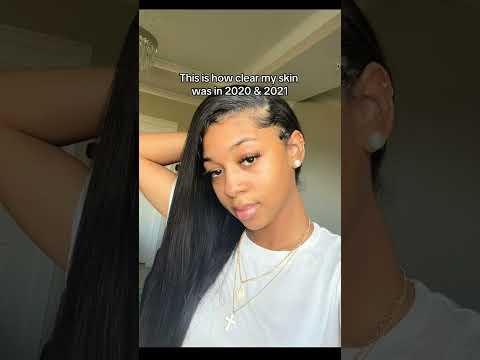 #Lupus Hair Loss