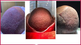 زراعة الشعر- جميع المراحل 4700 بصيلة