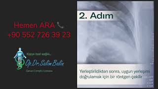 Yutulabilir Mide Balonu Ile Fazla Kilolara Zorlanmadan Veda Edin 📍