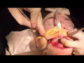 Extraction des dents de sagesse7
