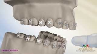 Putting Braces On or Bonding - Indirect Technique