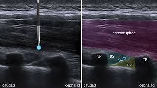 Ultrasound guided thoracic paravertebral block