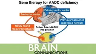 Download Lagu Dopaminergic restoration of prefrontal cortico-putaminal network in gene therapy for AADC deficiency MP3