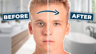 TEEN ACNE? STOP DOING THESE 5 THINGS! l Alex Costa