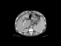 Transjugular intrahepatic portosystemic shunt tips