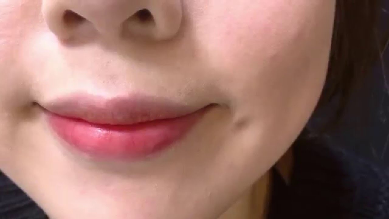 微笑加糖 謝氏超自然梨窩手術 連結 Http Photopgiment Pixnet Net Blog Post 359289552 Youtube