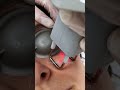 Rejuvenecimiento facial sin baja médica