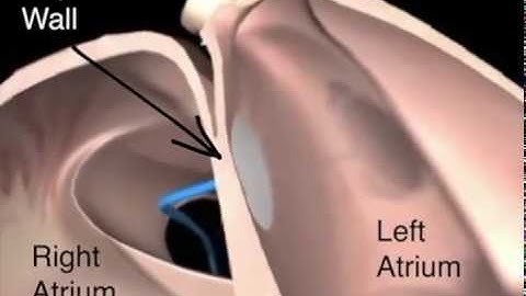 Installation of Atrial Septal Occluder video with labels