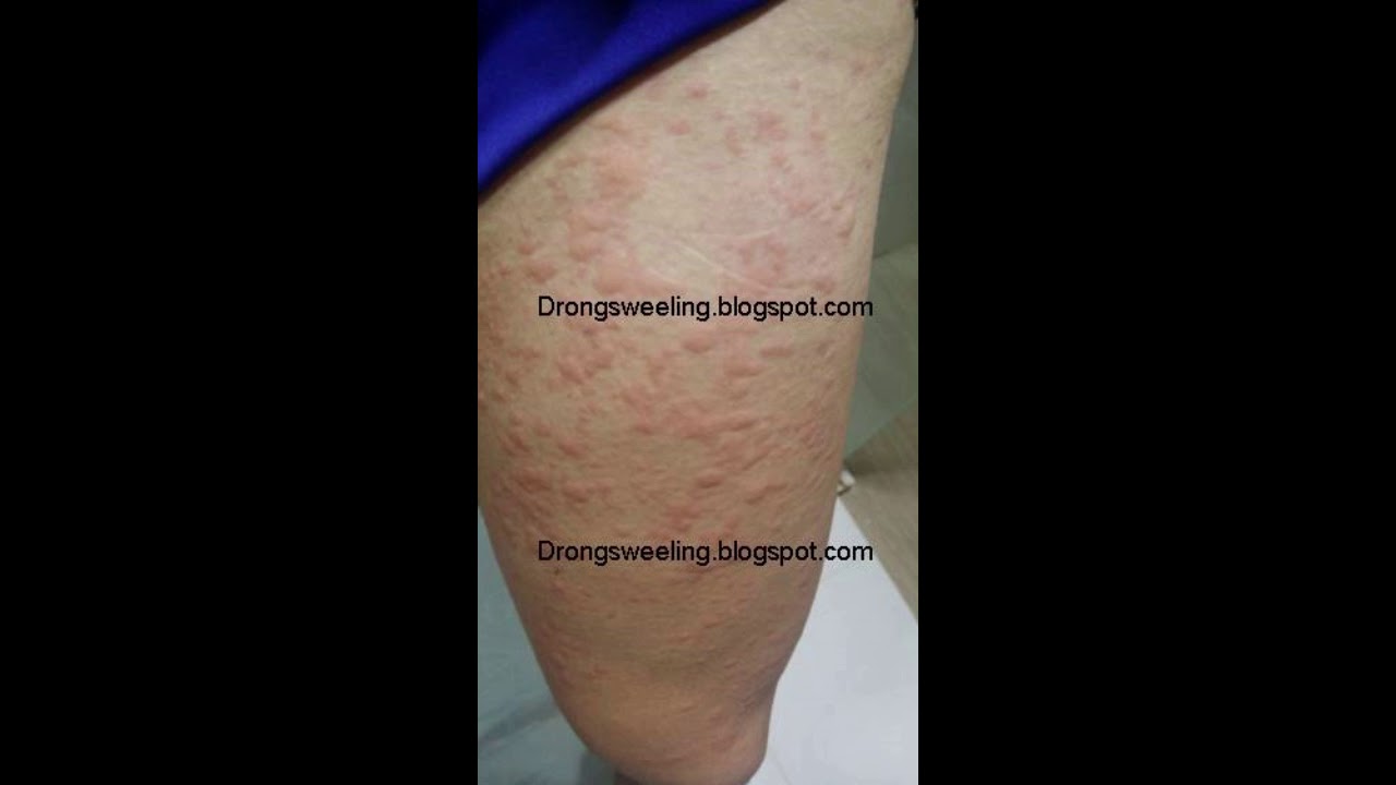 Hives TCM Treatment in Singapore for Hives at Eastern Healing TCM