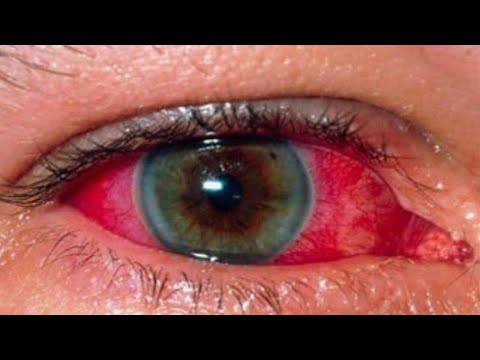 كيفية علاج احمرار بياض العين منزليا بدقائق