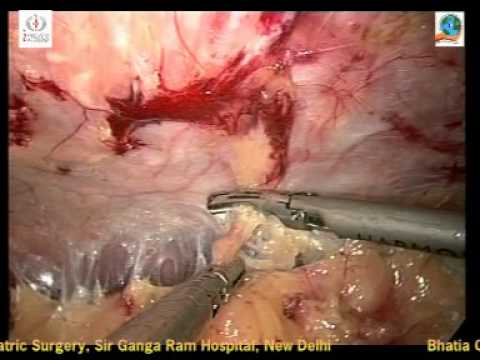 Laparoscopic Ventral Hernia Repair