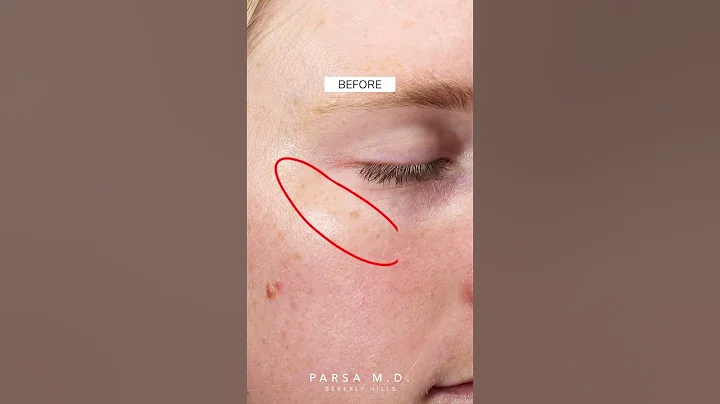 Before and After IPL Laser (LUMECCA)| Kami Parsa, M.D. | PARSA MD #skincare