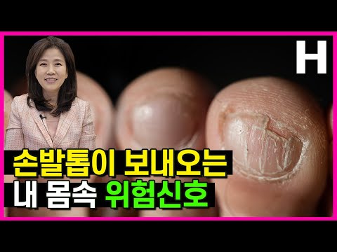 손톱에 나타나는 위험신호! 손톱의 세로줄 검은줄이 나타내는 내 건강의 위험신호는?