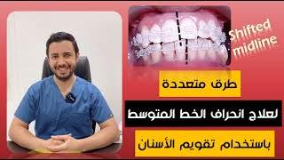 طرق مختلفة لعلاج انحراف الخط المتوسط باستخدام تقويم الأسنان.  Treating shifted midline with braces.