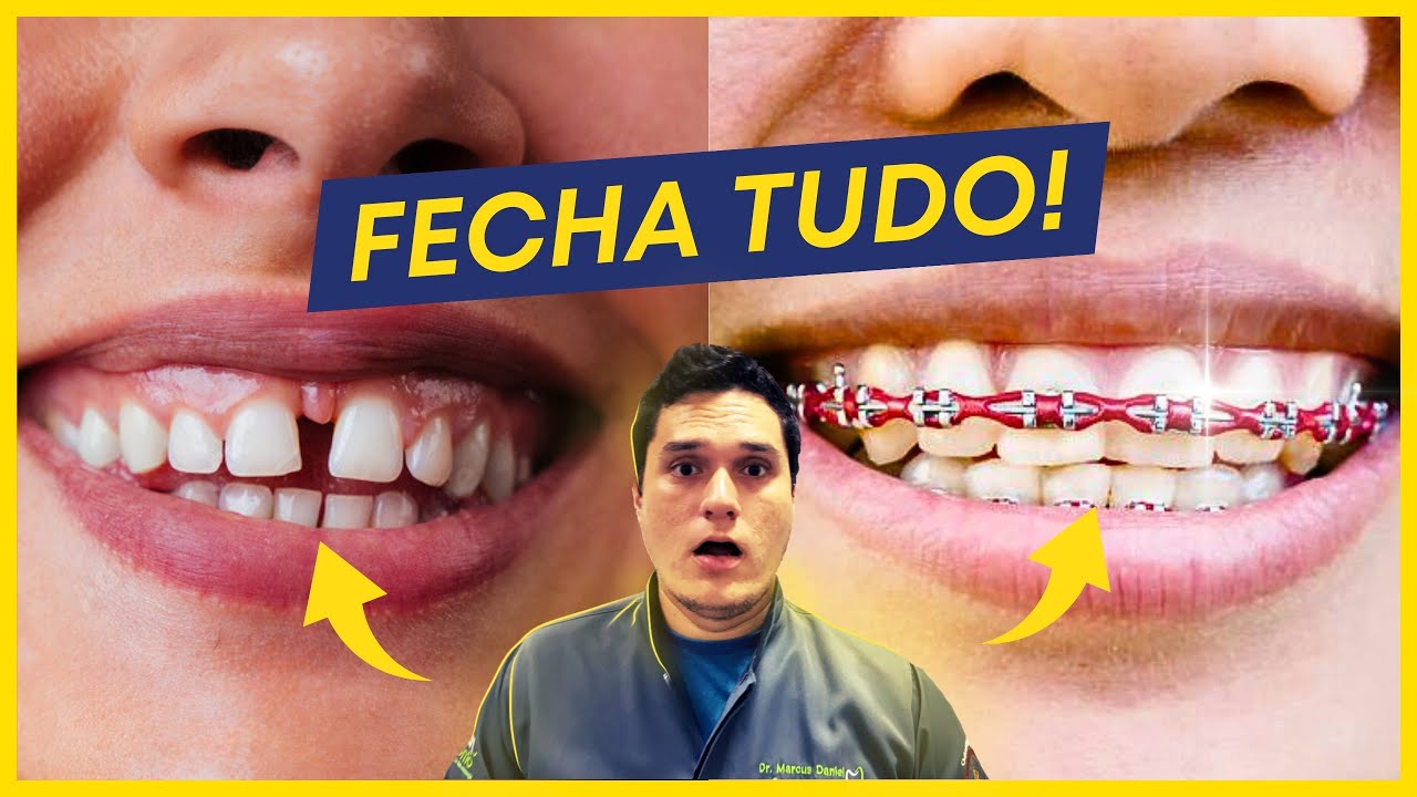 Confezione Da 5000 Elastici Dentali Per Ortodonzia, 4.5 Oz, Varie Taglie A Scelta &ndash; Gommini Per Apparecchio