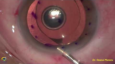 My first (preloaded) DMEK