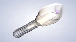 Dental Implant Procedure in Grove City, OH | Greater Columbus Oral Surgery & Dental Implants