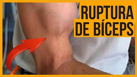 O que acontece com o bíceps femoral?