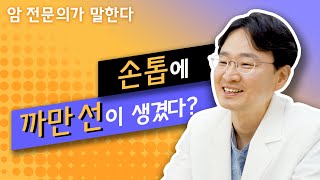 Q. 손톱에 까만 선이 생겼다? 어떻게 해야 하나요? [피부암]
