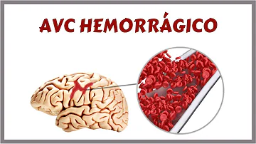 Quais os sintomas de AVC hemorrágico?