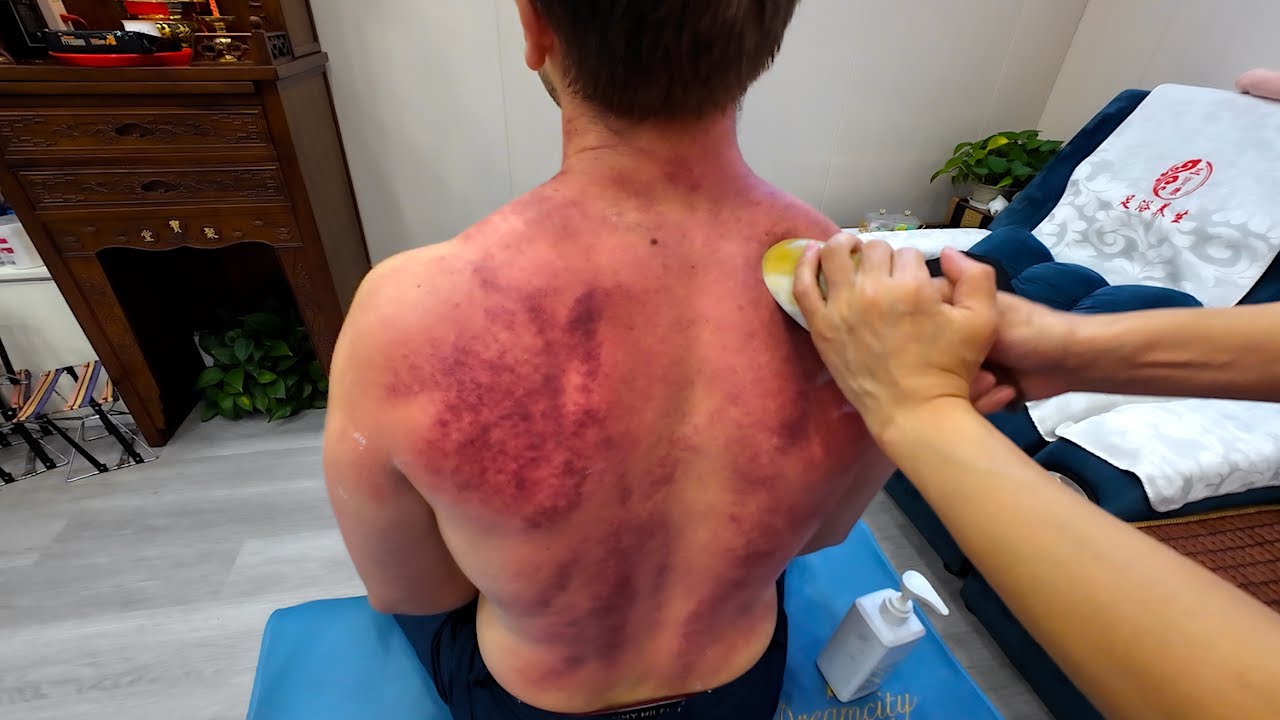 ASMR: Gua Sha Massage in China Left My Back Seriously Bruised