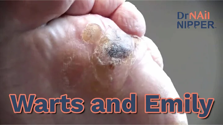 Throwback - Warts with Emily
