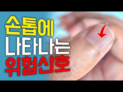 손톱에 &rsquo;이런 줄&rsquo; 보이면 암이 올 수 있다고 합니다