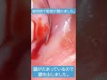 歯周病で歯茎が腫れました 膿がたまっているので膿を出しました Short 歯周病で歯茎が腫れました 膿がたまっているので膿を出しました Short