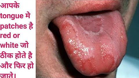 Tongue redness, Tongue infection, Tongue red and white Patches ,what are causes of tongue infection.