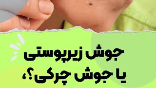 جوش زیرپوستی با جوش‌های چرکی فرق دارن؟