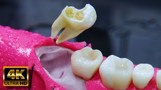 SEMI RETAINED wisdom tooth EXTRACTION explained.