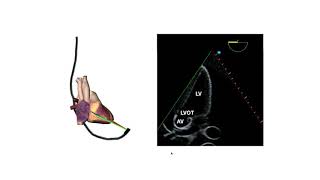 How to perform a transeosphageal echo (TOE)