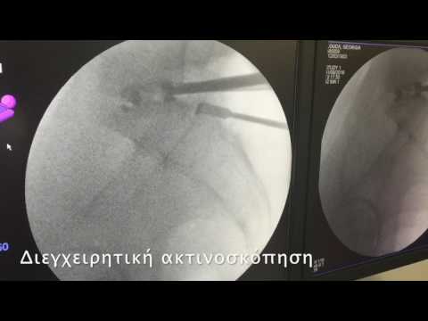 διατρηματική οσφυική διασωμάτιος σπονδυλοδεσία TLIF 
