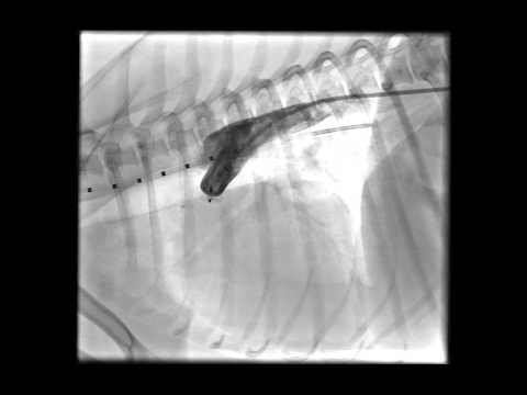 Video: Ductus arteriosus beim Fötus verbindet?