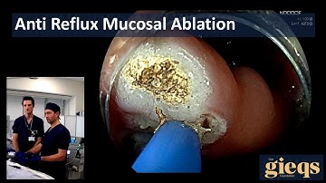 Anti-Reflux Mucosal Ablation