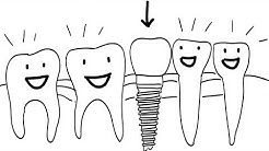 Why You Should Consider Dental Implants | Cosmetic & Family Dentistry Of Las Colinas