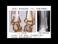 超音波画像からみえる足関節拘縮に対する評価と治療