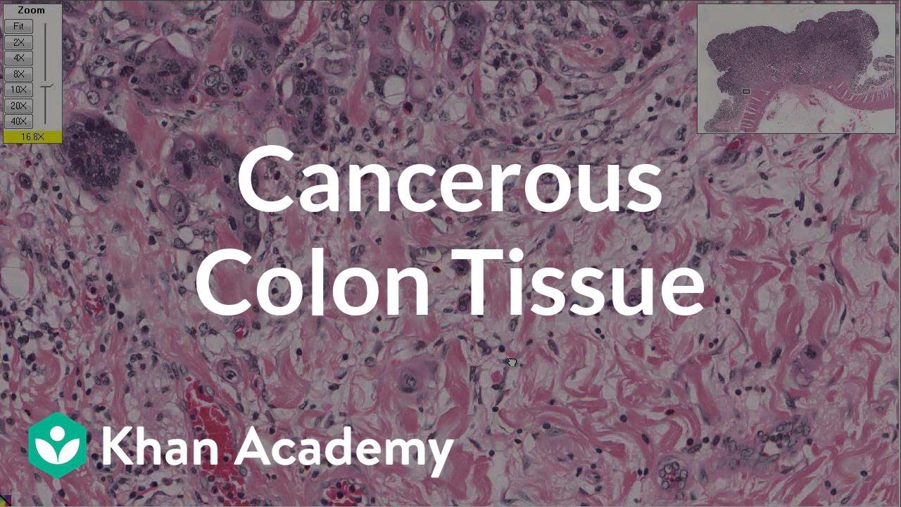 ⁣Cancerous colon tissue | Gastrointestinal system diseases | Health & Medicine | Khan Academy