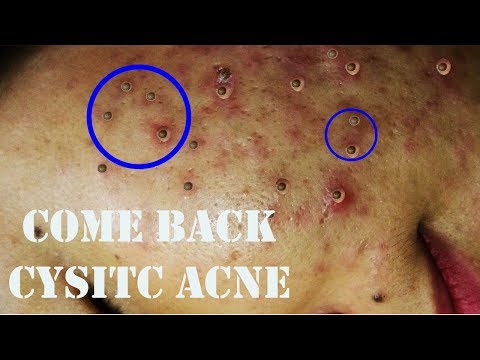 Cysitc Acne, Pimples And Blackheads Extraction Acne Treatment On Face!