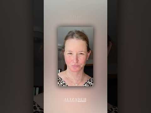 Facelift Patient Selfies | Dr. Alizadeh