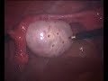 Management of polycystic ovaries dr nutan jain india