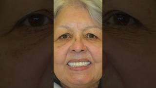 Milagros came to us with failing dental implants — and left with a smile that says it all! #allon4