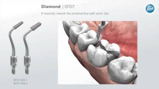 Preparation rules for ceramic inlays and partial crowns