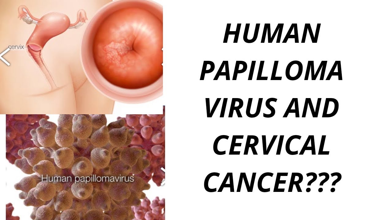 Papilloma xesteliyi. Papilloma xal, Papilloma xali