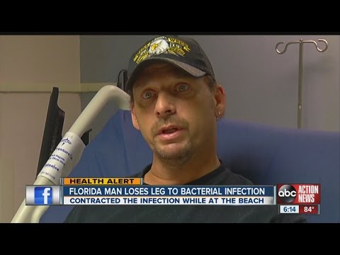 Ft. Myers man blames bacteria for loss of leg