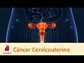 Cáncer Cervicouterino (CaCU)