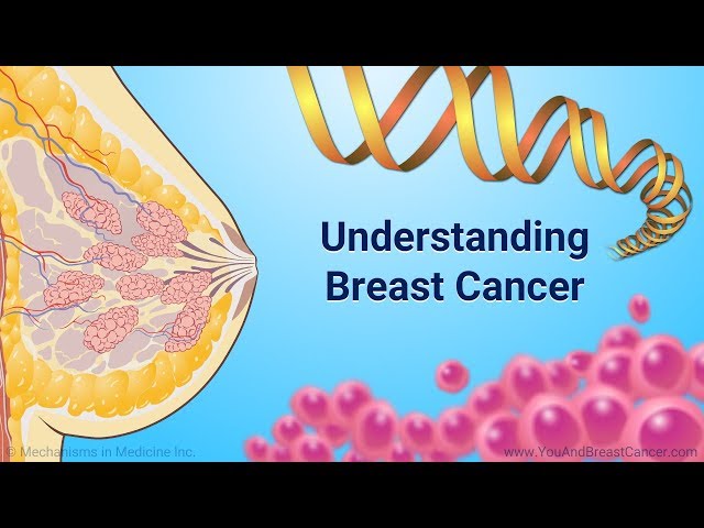 Understanding Breast Cancer class=