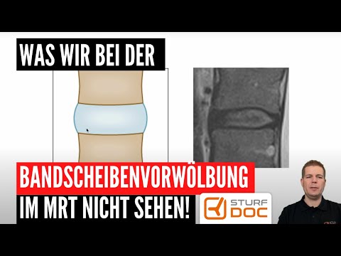 Video: Sind Bandscheibenvorwölbungen dauerhaft?